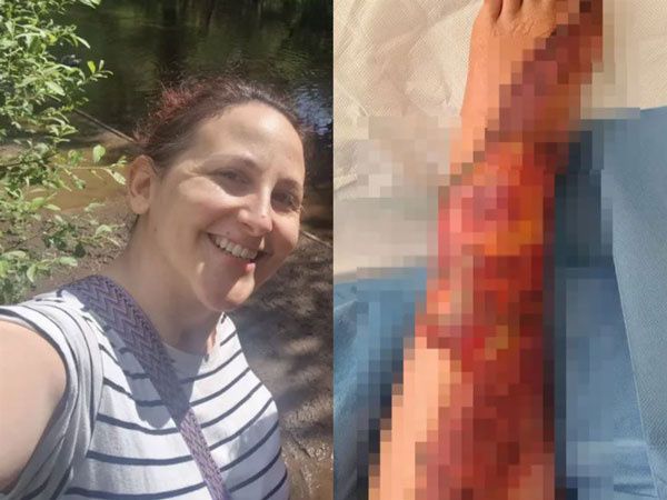 샤워 하다가 심각한 화상 입은 30대 여성, 이 증상 때문이라는데