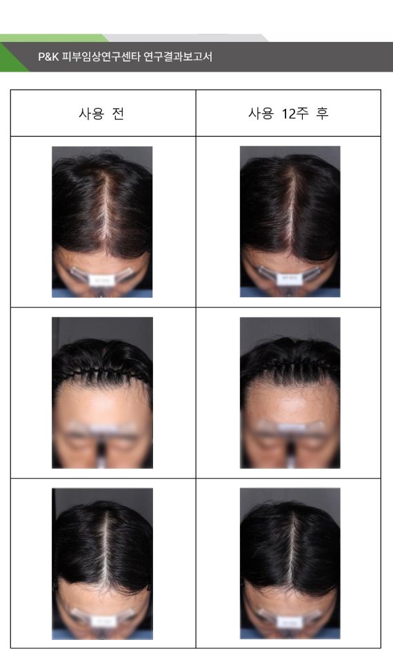 ▲ 국립산림과학원에서 의뢰한 “보리밥나무추출물 시험제품의 탈락 모발 수, 두피 탄력, 두피 보습, 모발 밀도, 모발 굵기, 모발 길이에 대한 인체적용시험”의 임상연구 참여자 전후 사진 (사진=국립산림과학원 P&K 피부임상연구센타 제공)