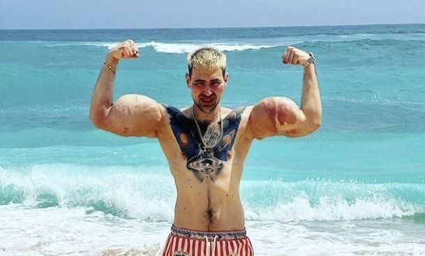 화학물질로 근육 키운 러시아 뽀빠이 근황, 양팔이..