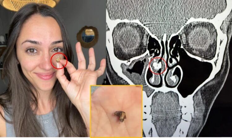 35년간 코 깊숙이 박혀있던 것이… "숨 안 쉬어졌던 이유"