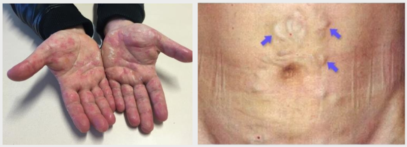 왼쪽은 간경변 환자에게 흔히 나타나는 손바닥 홍반(붉은 반점), 오른쪽은 복부 정맥이 비정상적으로 부풀어 오르는 ‘메두사 머리’ 증상. 사진=온라인 커뮤니티