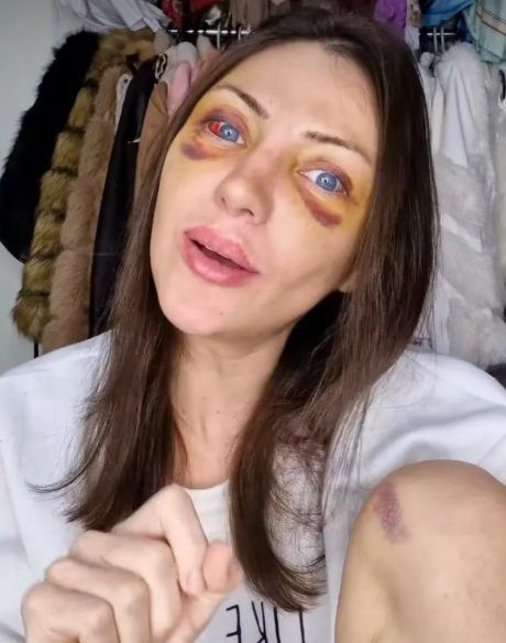 사망 몇 주 전에 안면 거상술을 받은 후 SNS에 올린 사진. 출처=SNS