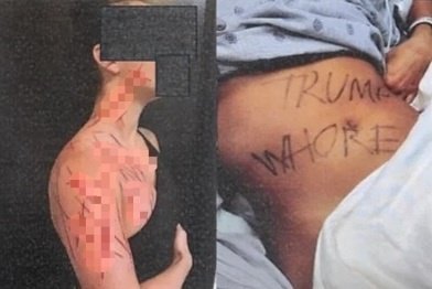 [서울=뉴시스] 전직 공화당 보좌관 나탈리 그린(26)이 몸에 난 상처와 낙서. (사진 출처: 뉴욕포스트 캡처)2025.12.04.