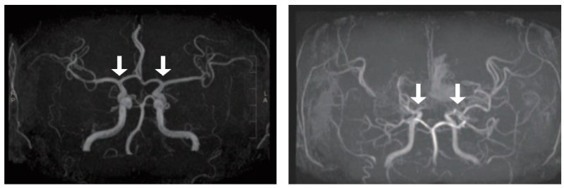 [서울=뉴시스] 사진 왼쪽부터 정상 및 모야모야병 환자의 뇌혈관. (사진= 서울대병원 제공)