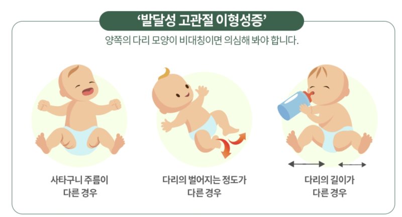 [서울=뉴시스] 10일 분당서울대병원에 따르면 발달성 고관절 이형성은증 출생시부터 고관절이 잘 형성이 안돼 엉덩이뼈에서 허벅지 뼈가 빠져있는 것을 말한다. (사진=분당서울대병원 제공) 2025.12.10. photo@newsis.com *재판매 및 DB 금지