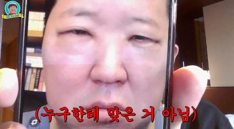 "큰 병 앓는 사람 같았다"…정형돈, 성형 후 퉁퉁 부은 눈 공개