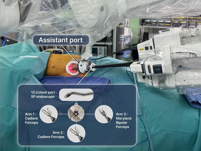 [서울=뉴시스] 김현구·이준희 고려대 구로병원 심장혈관흉부외과 교수 연구팀이 갈비뼈 밑 4㎝ 크기의 절개창 하나만을 이용하는 '단일공 로봇수술'과 기존 '다공 로봇수술'을 비교 분석한 결과 단일공 수술이 수술 시간 단축 및 회복 속도 면에서 더 우수한 것으로 확인됐다. (사진= 고려대 구로병원 제공)