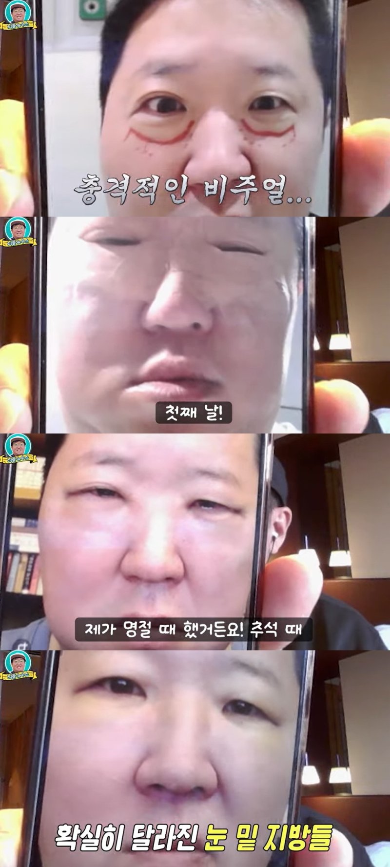 정형돈, 성형 후 충격적 부기 공개…"일주일 동안 못나가"