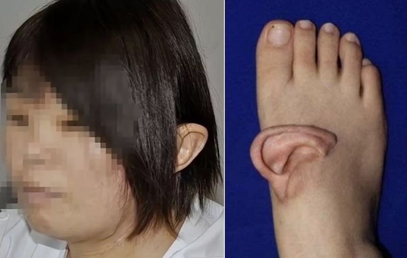 중국에서 사고로 완전히 뜯겨나간 귀를 발등에 임시 이식해 살려낸 뒤 5개월 만에 재부착에 성공했다. 사진=미러