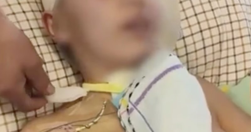 [뉴시스] 교통사고로 머리 외상, 얼굴 부상, 골절 등의 부상을 입고 개두술 후 혼수상태에 빠져있던 류전예 씨 며느리의 모습. (사진 = 바이두 캡처) 2025.12.11. *재판매 및 DB 금지