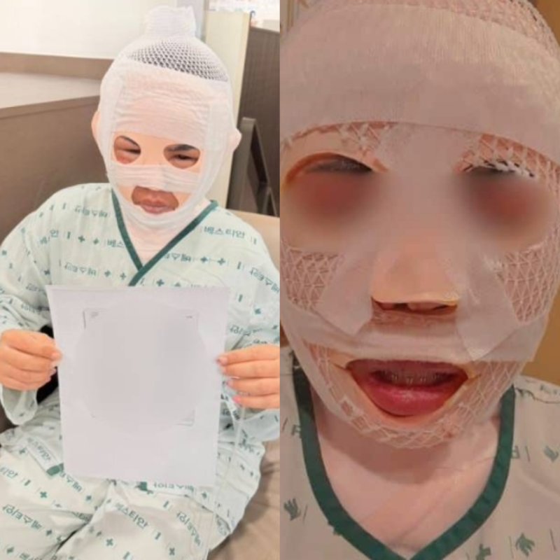 [뉴시스] 태국인 여성이 한국인 남자친구에게 끓는 물을 맞아 얼굴에 심각한 화성을 입었다고 밝혔다. 피해 여성은 현재 서울의 한 병원에 입원 중인 것으로 알려졌다. (사진 = 페이스북 갈무리) 2025.12.10. *재판매 및 DB 금지