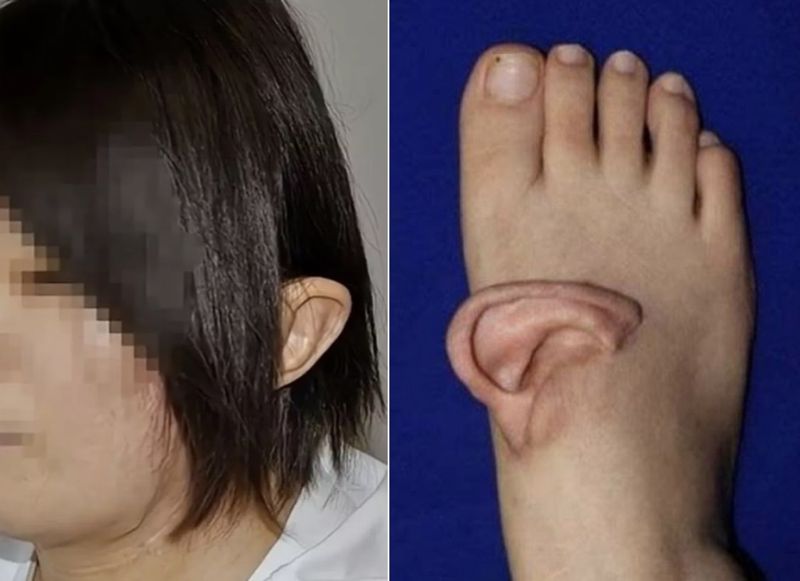 "발등에 귀가 붙었다?"…5개월 동안 女 벌어진 일