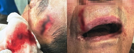 [단양=뉴시스] B씨가 입은 상처 (사진= 독자 제공) photo@newsis.com *재판매 및 DB 금지