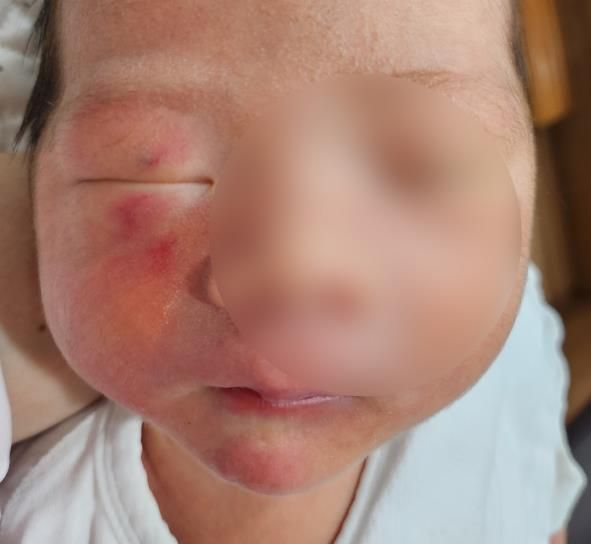 생후 4일 아기 얼굴에 멍·상처, 신생아실에서 무슨 일이?