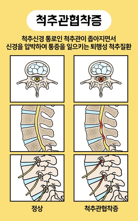 척추관협착증은 노화로 인해 척추 주변 조직이 두꺼워지거나 변형되면서 신경이 지나가는 통로인 척추관이 좁아지는 질환이다. /게티이미지뱅크