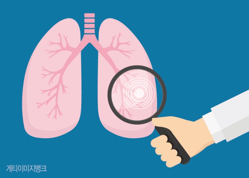 담배 피운 적 없는데... 간접흡연·요리매연에 여성 폐암 급증 [Weekend 헬스]