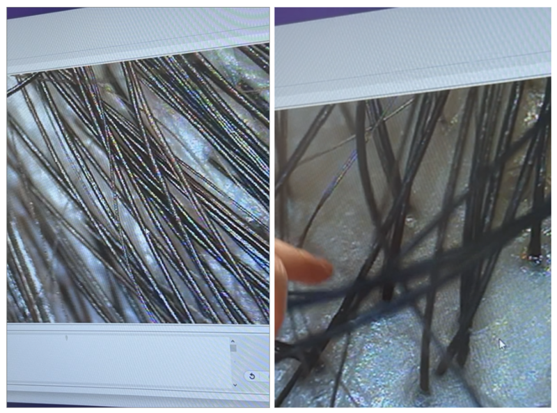 두피 확대경을 통해 확인한 후두부 모발(좌)과 정수리 모발(우). 후두부는 모발의 굵기가 일정하며 밀도도 높은 편이다. 정수리의 모발은 가늘어진 모발이 눈에 띈다.[나의 탈모 해방일지]