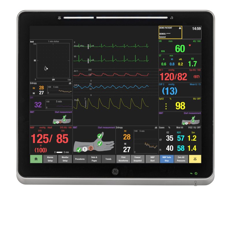 GE헬스케어의 환자모니터링 시스템 케어스케이프 캔버스(CARESCAPE Canvas)에 표기되는 'SPI 지표'. (GE헬스케어 제공)