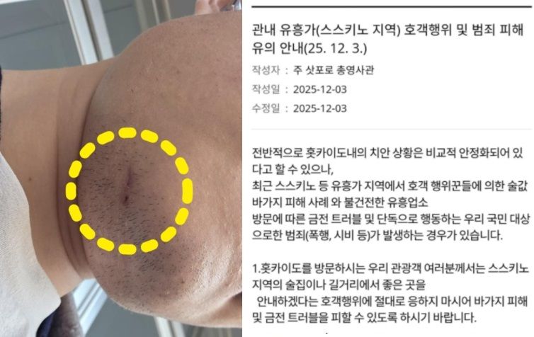 일본에서 집단폭행으로 A씨는 하악 앞니 3개가 부러지는 ‘치관 파절’과 신경 손상 진단을 받았다. 사진=동아닷컴