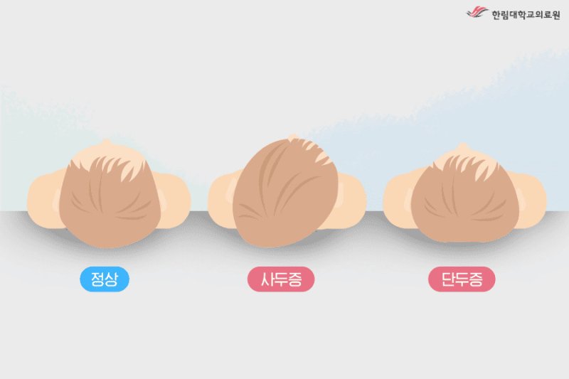 [서울=뉴시스] 자세형 사두증의 유형. (사진= 한림대동탄성심병원 제공) /사진=뉴시스