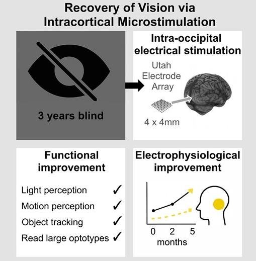 대뇌 시각피질 전기자극을 이용한 실명 환자 시각 회복 과정 (출처=연합뉴스)