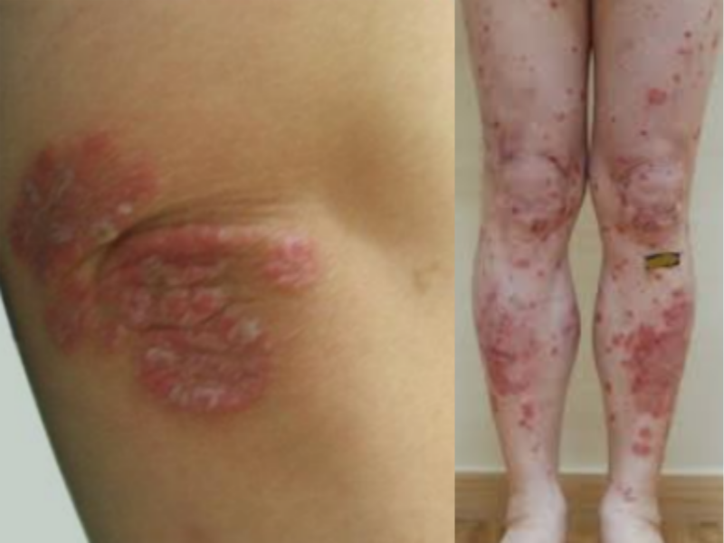 건선의 가장 특징적인 증상은 은백색의 두꺼운 각질로 덮인 경계가 뚜렷한 붉은 발진이다. 처음에는 좁쌀 같은 작은 발진으로 시작하지만, 시간이 지나면서 주변 병변과 합쳐지거나 커지며 넓은 부위로 퍼진다. 병변은 주로 팔꿈치, 무릎, 두피, 엉덩이 등 마찰이나 자극을 많이 받는 부위에 나타난다. /사진=파이낸셜뉴스 DB