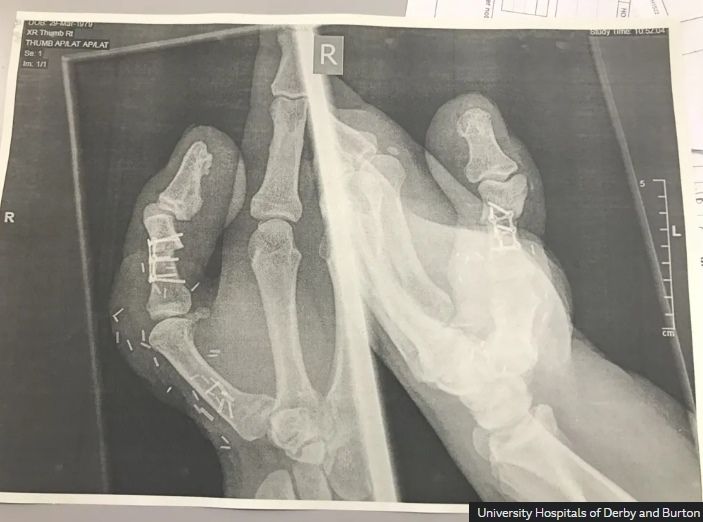 엄지손가락 잘린 40대男, 손가락 대신 '이것' 붙여 일터 복귀 '화제'