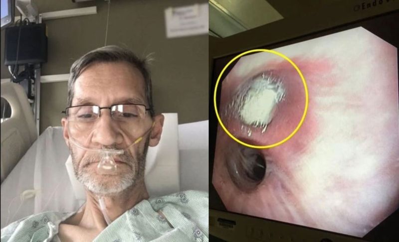 '먼지 한 톨'의 비극…결국 폐 적출한 남성  