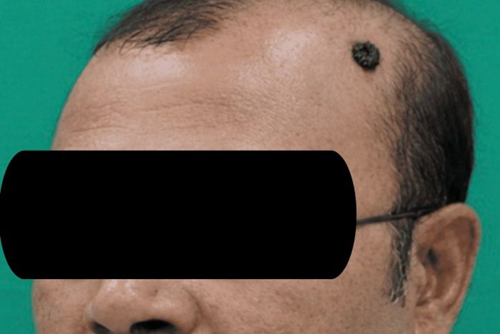 20년 된 점인 줄 알았는데…알고 보니 두피서 자란 '암'  