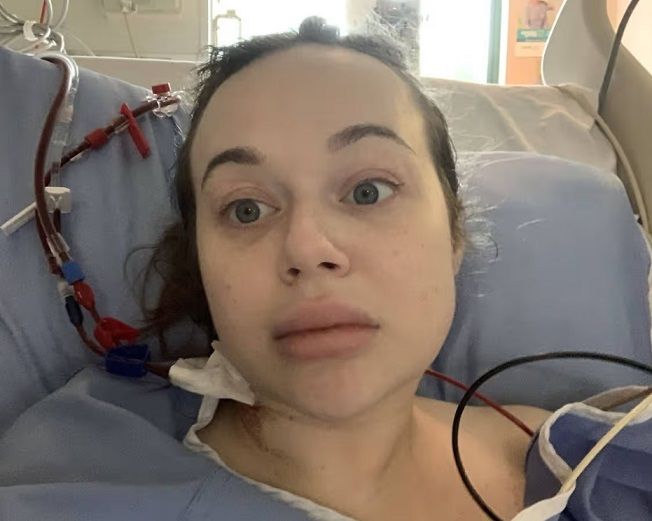 술을 마신 뒤 의식을 잃고 쓰러졌다가 하룻밤 사이 다리가 심하게 부어 오르는 급성 응급상황을 겪은 여성. 출처=더 미러