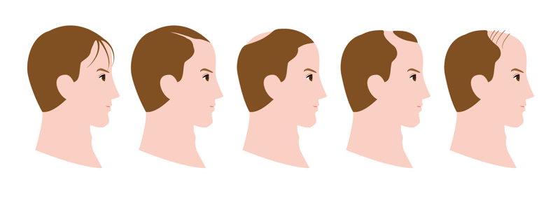 탈모 유전을 파악하기 위해 가족에게 탈모가 있을 경우, 탈모 유형을 기입한다. 그림으로 표현한 남성 탈모의 종류. 이마가 M자로 넓어지는 경우, 정수리에서만 탈락이 일어나는 경우 등 다양하다. 사진: 셔터스톡