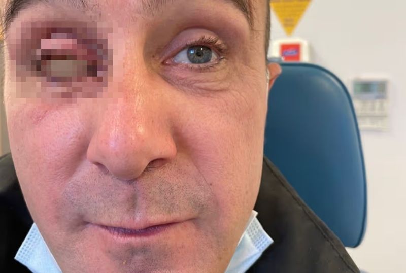 가족들과 휴가 갔다 한쪽 눈 잃은 40대男, 수영장서 벌어진 끔찍한 사고  