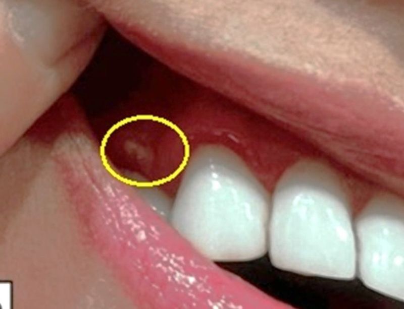 40대 女, 단순 피부 질환인 줄 알았는데 '천포창' 확진  