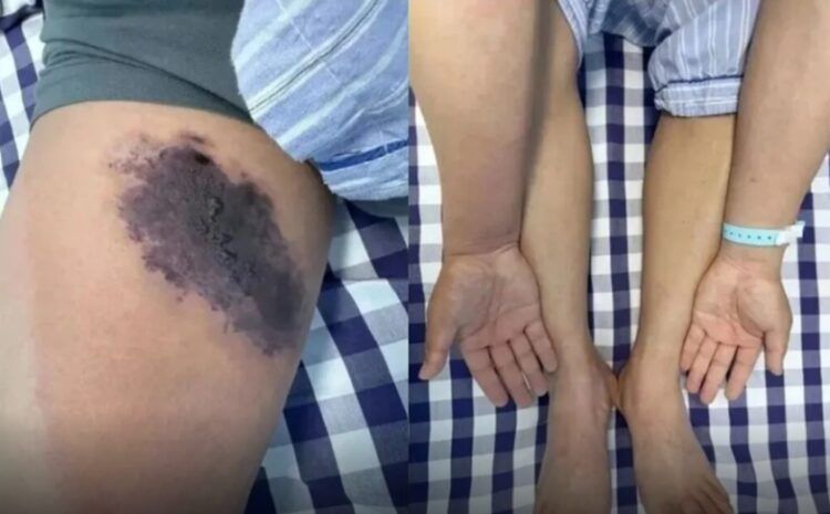 낡은 청바지 입었다가 '날벼락'... 거미에 물려 피부 괴사된 남성  