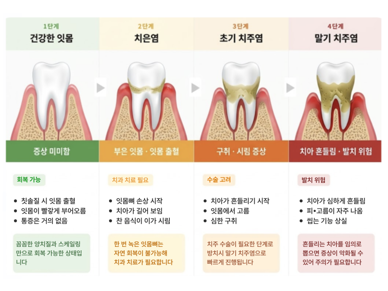 단계별로 보는 풍치(만성 염증성 치주질환)의 증상. /사진=Gemini, Notebook LM