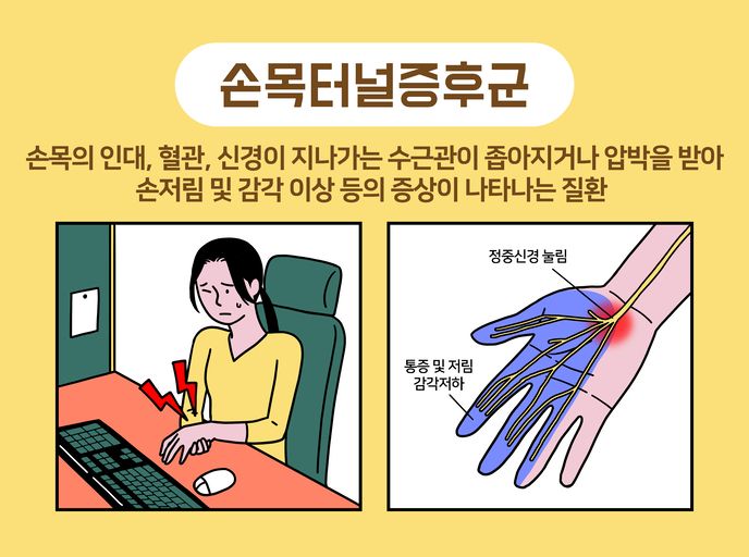 손목의 정중신경이 눌리면 엄지부터 약지 절반 까지의 감각에 이상이 생기고 통증이 발생한다. /사진=게티이미지뱅크