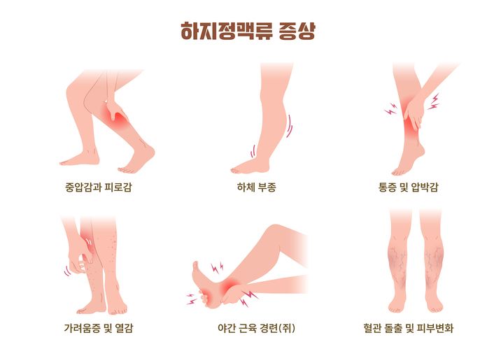 판막 이상으로 생기는 하지정맥류는 혈관 돌출이 없는 '잠복성'이 더 흔하다. 다리가 자주 붓거나 묵직하다면 의심해봐야 한다. /사진=게티이미지뱅크