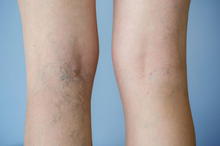 정맥 내 판막은 한 번 손상되면 자연적으로 회복되지 않는다. 시간이 갈수록 역류하는 혈액이 늘어나면서 정맥 벽까지 함께 늘어나기 때문에, 시간이 지날수록 악화되고 새로운 증상이 동반될 수 있다. /사진=게티이미지뱅크
