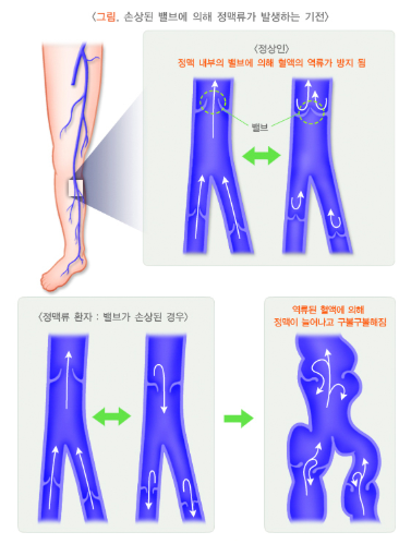 하지정맥류는 다리에서 심장으로 혈액을 올려보내는 정맥의 판막이 망가지면서 혈액이 다리 쪽으로 역류해 고이는 혈관 질환이다. /사진=질병관리청 국가건강정보포털