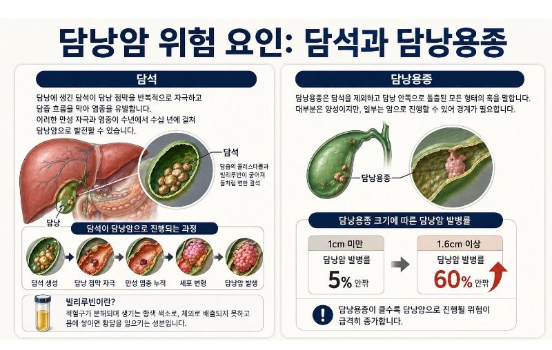 담낭암의 대표적인 발병 원인으로는 담석과 담낭용종이 꼽힌다. 기사의 이해를 돕기 위해 AI를 활용해 제작한 인포그래픽. /사진=ChatGPT