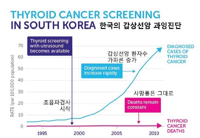 세계 1위 '갑상선암 대국' 한국, 그 오해와 진실 [안철우 교수의 호르몬 백과사전]