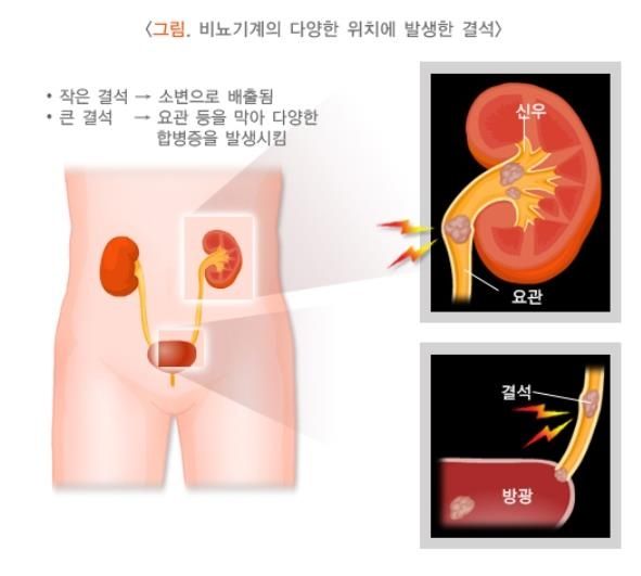 /사진=질병관리청 국가건강정보포털 캡처