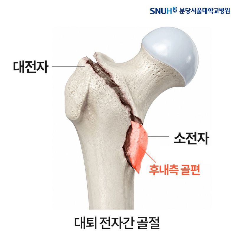 고관절 골절 수술 상식 뒤집혔다…"조각 안 잡아도 붙는다"