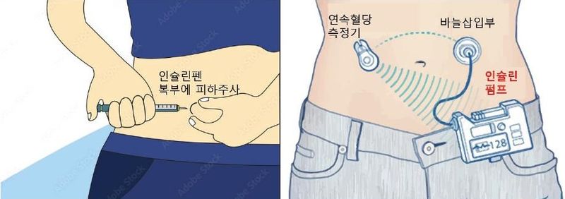 인슐린 펜과 인슐린 펌프