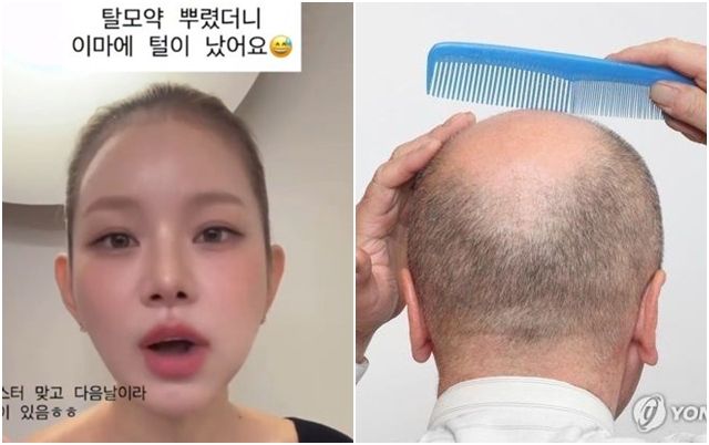 맹승지 "바르는 탈모약 이마에 흘렸더니 잔머리가 났어요"