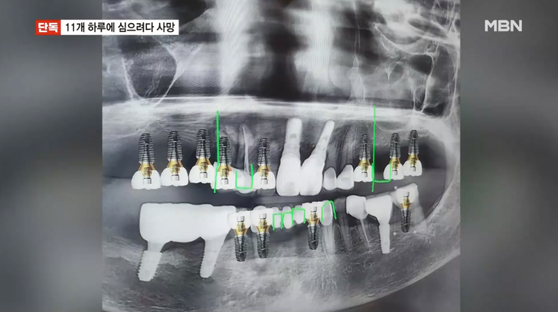 70대 A씨는 임플란트 11개를 동시에 식립하는 수술 중 허용량의 3배에 달하는 국소마취제를 투여받고 16분 만에 이상 반응을 보인 뒤 숨졌다. /사진=MBN뉴스 갈무리