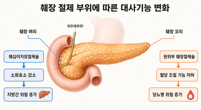췌장 절제 부위에 따른 대사기능 변화 개념도. 분당서울대병원 제공