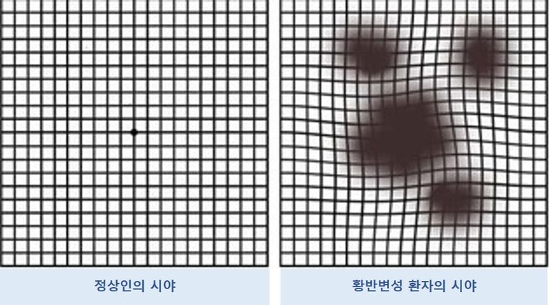 "글자가 흔들려 보이는 이유, 노안이 아니었다" [헬스톡]