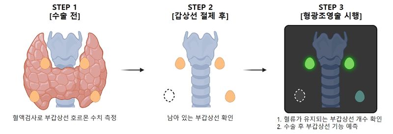 형광조영술 기반 로봇 갑상선 후 부갑상선 기능 예측법 개념도 수술 전 부갑상선 기능과 수술 중 로봇 형광조영술로 확인한 부갑상선 혈류를 연구팀이 만든 계산식에 대입하면, 환자 10명 중 7명에서 수술 후 부갑상선 기능을 오차 범위 내로 미리 예측할 수 있다. 분당서울대병원 제공