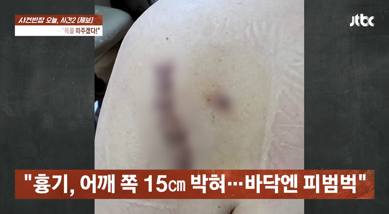 흉기에 찔린 B씨의 어깨 부위. 흉기가 약 15㎝ 깊이로 박히면서 동맥이 끊어져 봉합 수술을 받았고, 전치 4주 진단이 나왔다. /사진=JTBC '사건반장'